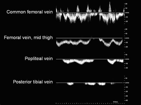 Pdf Doppler Ultrasonography Of The Lower Extremity Arteries Anatomy And