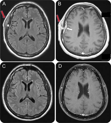 Teaching Neuroimages Skull And Dural Lesions In Neurosyphilis Neurology