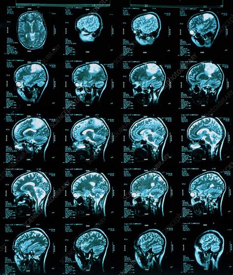 Brain Cancer Scans Stock Image M134 0280 Science Photo Library