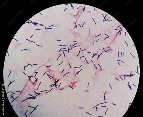 Smear of human blood culture Gram's stained with gram positive bacilli ...