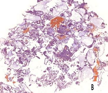 A-Congo red stain showing mildly positive in complete mole x4. B-Congo ...