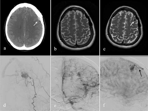 A Initial Contrast Enhanced Computed Tomography Scan Demonstrating A