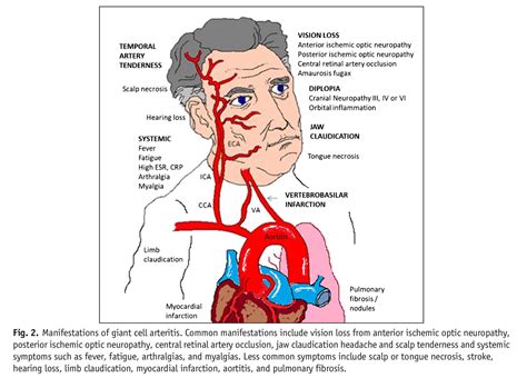 Arteritis De Células Gigantes