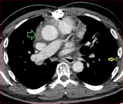 Thymic carcinoma | Applied Radiology