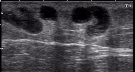 Superficial Thrombophlebitis Image Radiopaedia Org