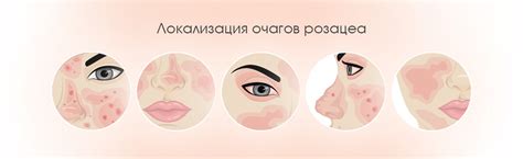 Розацеа на лице: как проявляется, причины, лечение, как поможет ...
