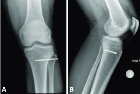 Anteroposterior A And Lateral B Radiographs Of The Knee 5 5 Months