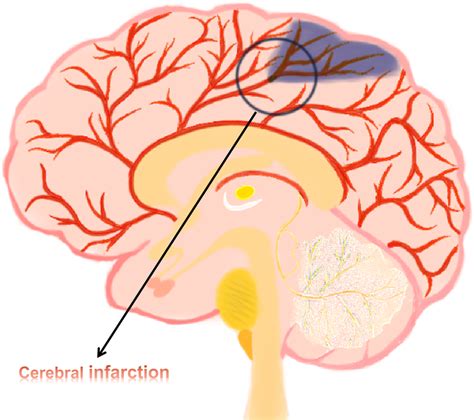 Cerebral infarction. This figure depicts the cerebral blood transport ...