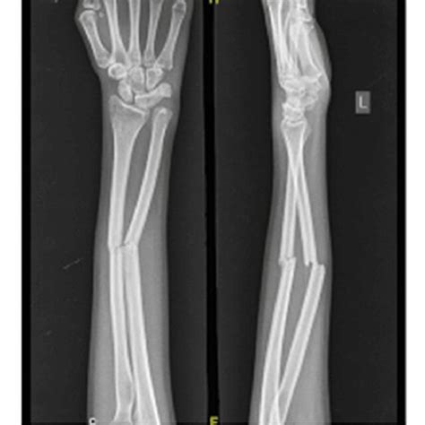 The Preoperative Forearm X Ray With Ununited Fracture Of Both Forearm