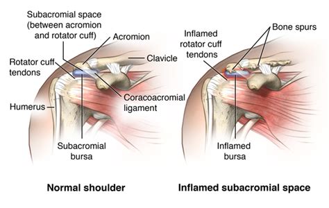 Bursitis Health Encyclopedia University Of Rochester Medical Center