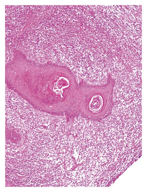 Dissecting Cellulitis Of The Scalp A Inflamed Granulation Tissue And