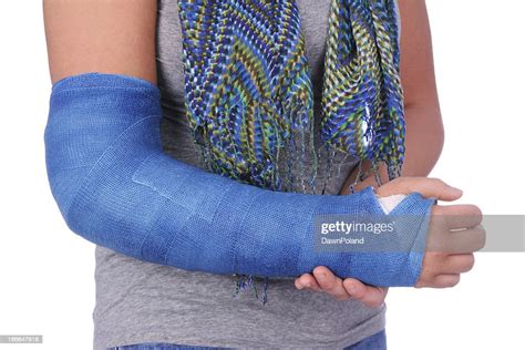 Broken Arm High Res Stock Photo Getty Images