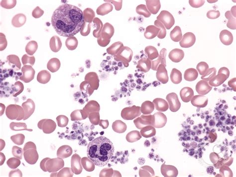 Essential Thrombocythemia 1