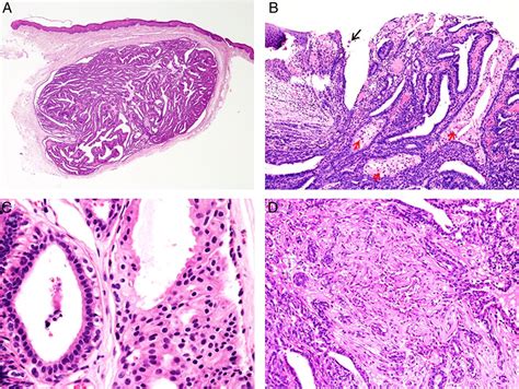 Pik3ca And Akt1 Mutations In Hidradenoma Papilliferum Journal Of