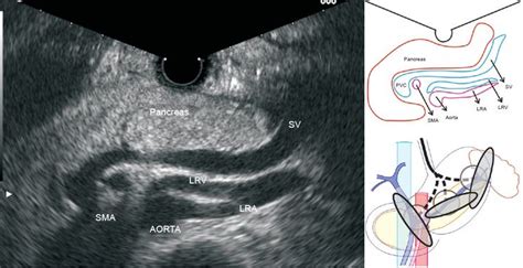 159 best images about VASCULAR on Pinterest | Portal, Internal carotid ...