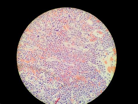 Bone Marrow Core Biopsy Pathology Disseminated Histoplasma Infection