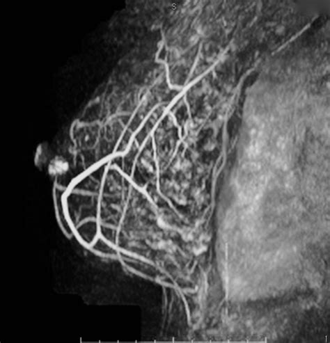 Brustkrebs Fr Herkennung Abtasten Ultraschall R Ntgen Oder Mrt