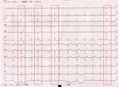 ECG shows a sinus rhythm with frequent PVCs. The red dashed box shows a ...