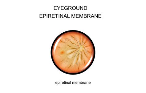 Epiretinal Membrane - ATHENS EYECARE CLINIC