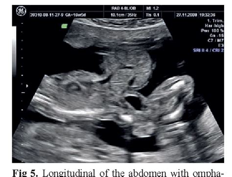 Figure 1 From The Fetal Abdominal Wall Defects Using 2D And 3D