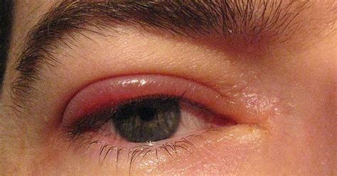 Granulated Eyelids Blepharitis Types Signs Diagnosis 54 Off