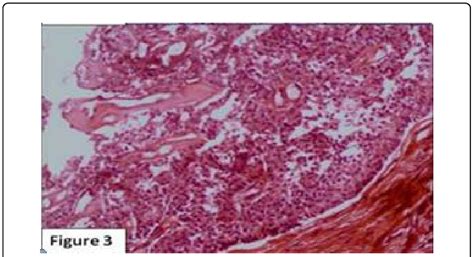 Photomicrograph Showing A Well Circumscribed Dermal Tumor With