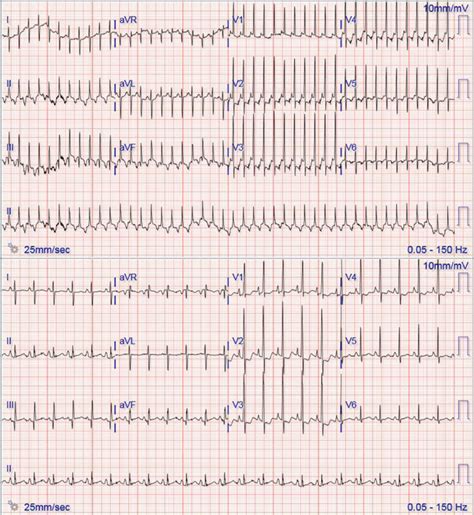 Twelve Lead Electrocardiogram From Case 2 Illustrating Supraventricular Download Scientific