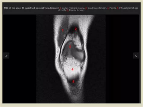 Presentation Pptx Radiological Anatomy Of The Knee Joint Ppt