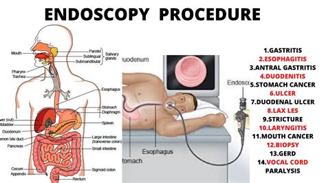 Upper endoscopy findings gi bleed - roofkool