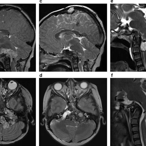 A B Primary Tumour Progression Aged 5 Years A Mid Sagittal T2 Weighted