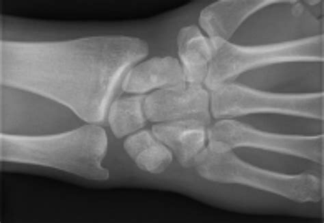 Hand And Wrist Acute Scaphoid Fractures Guidelines For Diagnosis And