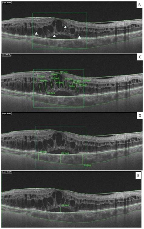 Diagnostics Free Full Text The Application Of Structural Retinal Biomarkers To Evaluate The