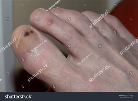 1 494 Melanoma Male 图片、库存照片和矢量图 Shutterstock