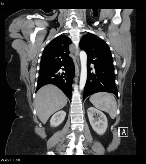 Foregut Duplication Cyst Image Radiopaedia Org