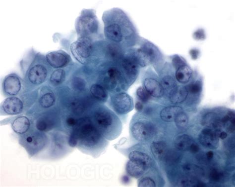 Cyst Breast Cytology