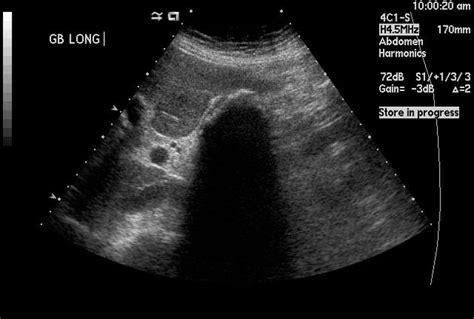 Porcelain Gb Sonographic Findings Gallstones 95 Hyperechoic Wall