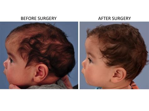 Minimally Invasive Endoscopic Sagittal Strip Craniectomy Before And