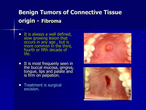 PPT Comprehensive Guide To Benign Oral Tumors PowerPoint Presentation