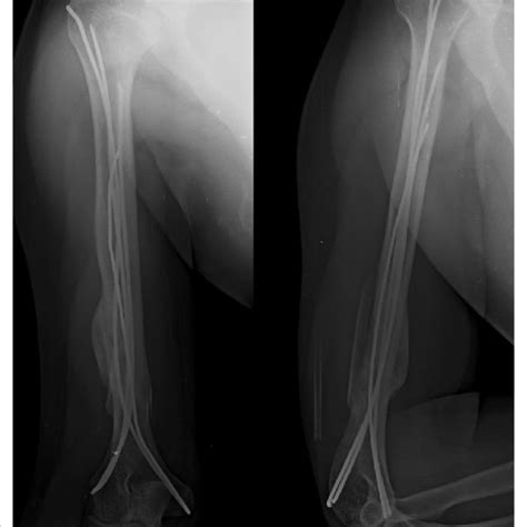 PDF Multiple Elastic Retrograde Intramedullary Nailing For Adult