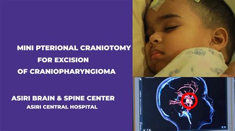 Mini Pterional Craniotomy For Excision Of Craniopharyngioma Surgery