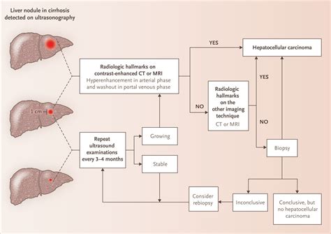 Hepatocellular Carcinoma | NEJM Resident 360