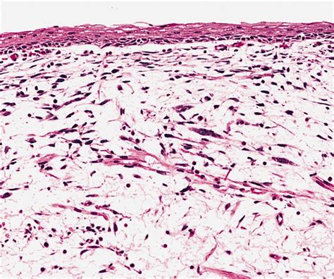 Pathology Outlines Embryonal Rhabdomyosarcoma