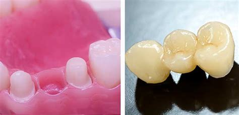 Options For Replacing A Single Missing Tooth The Denture Implant Clinic