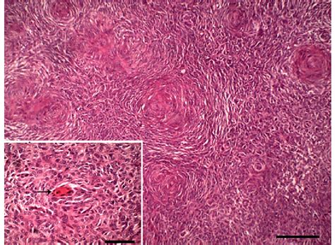 Plump Of Spindle And Epithelioid Neoplastic Cells And Bizarre Download Scientific Diagram