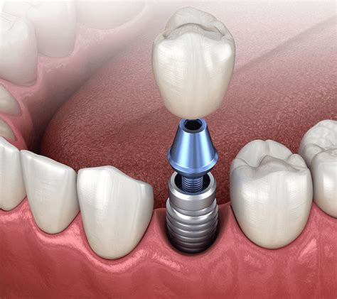 Dental Implant Abutment Crown