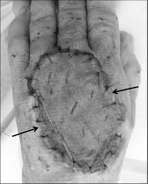 Figure 2 From Extensive Soft Tissue Necrosis Due To Extravasation Of