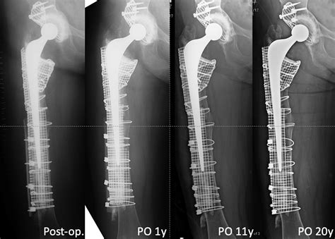 Impaction Bone Grafting For Femoral Revision Hip Arthroplasty With