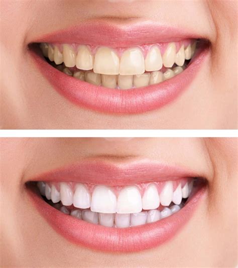 What You Should Know About Teeth Whitening