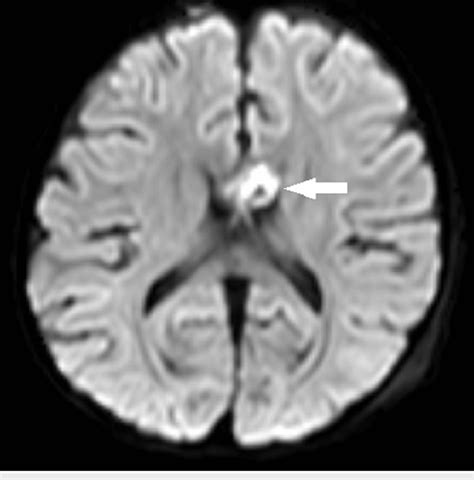 Axial Mri Brain Dwi Image Showing Focus Of Hyperintense Signal