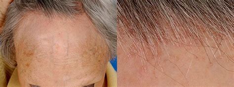 Alopecia Frontal Fibrosante Causas Y Tratamiento